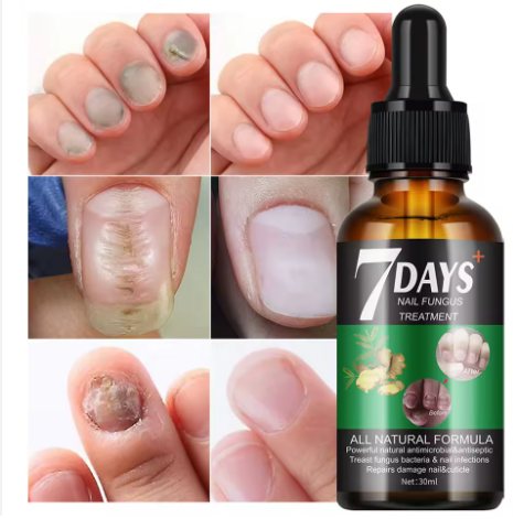 Sérum de Traitement des Champignons des Ongles 11500f