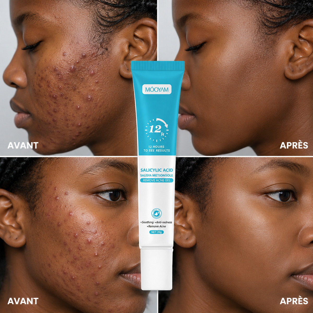 Crème anti-acné à l'acide salicylique 11500F